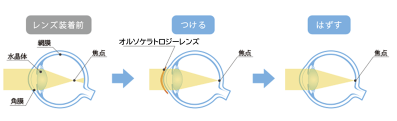 日中の裸眼生活が可能に